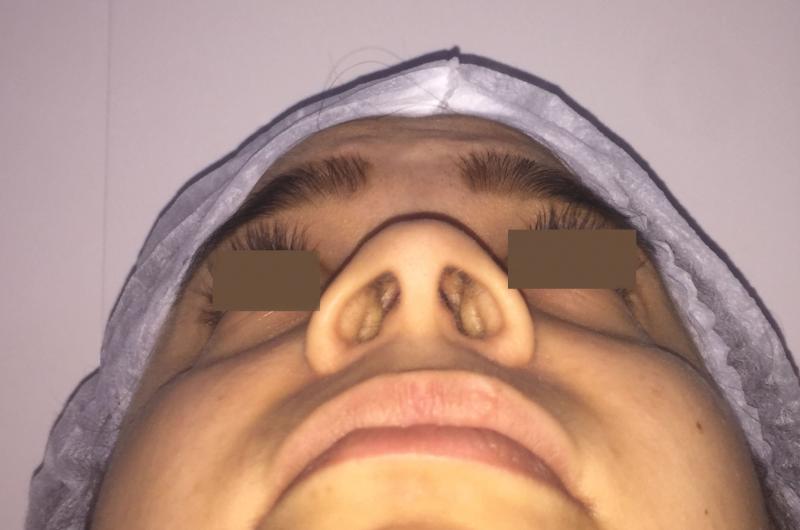 Open rhinoplasty, Open Nose Job, Wide alae Nasi, Nose hump, Best Plastic Surgery