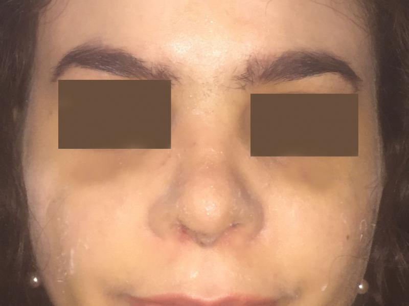Open rhinoplasty, Open Nose Job, Wide alae Nasi, Nose Tip, Best Plastic Surgery