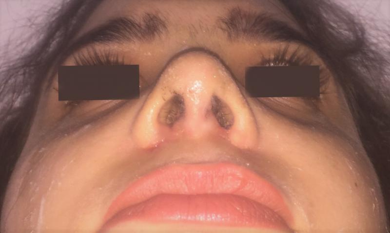 Open rhinoplasty, Open Nose Job, Wide alae Nasi, Nose Hump, Cosmetic Surgery