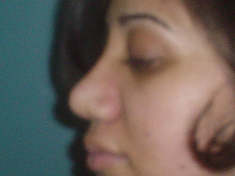 Cosmetic Surgery in Egypt, Rhinoplasty, Nose tip, Nose Base, Nose Hump,