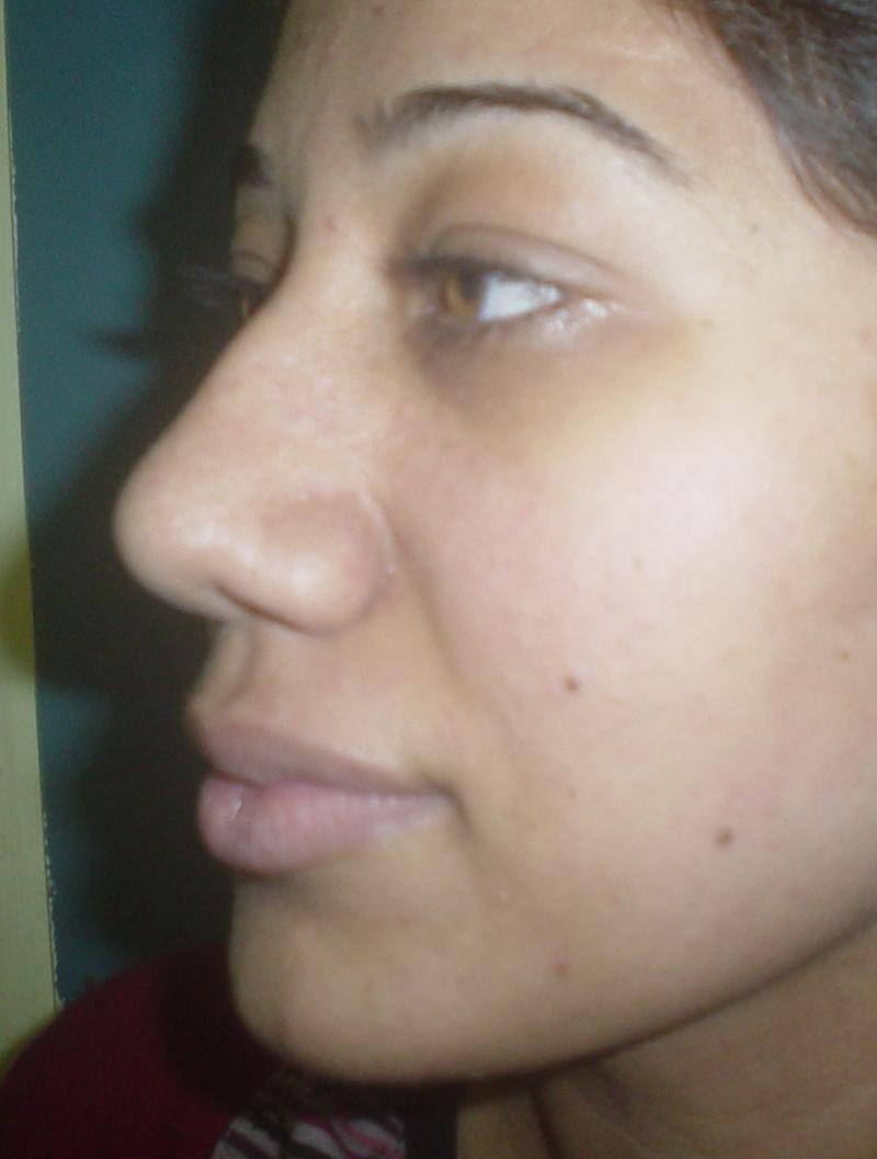 Plastic surgery Egypt, Nose Job, Rhinoplasty, Nose tip, Nose Hump, Nose Base