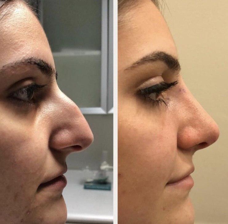 Rhinoplasty open, Rhinoplasty Closed, Nose Job, Dorsal Hump, Crooked nose, Tip
