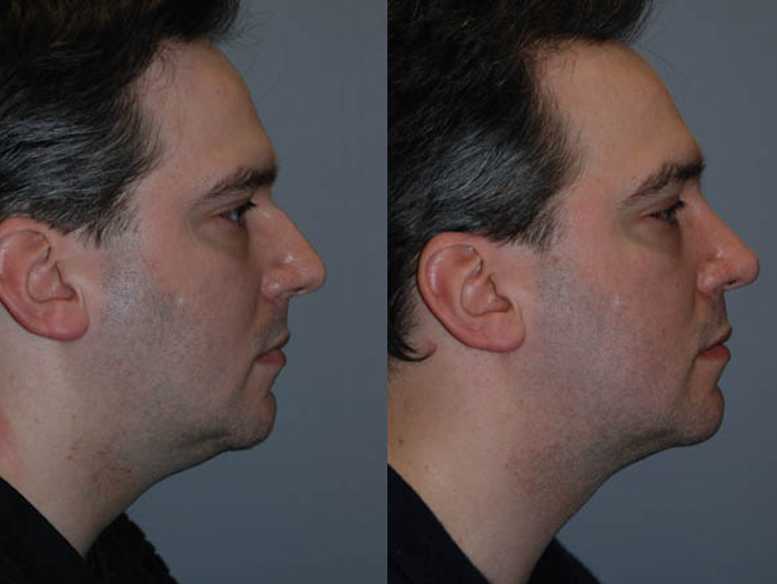 Nose Job, Rhinoplasty, Wide Tip, Boxy Tip, Broad Ala, Dorsal hump, Bull horn nos