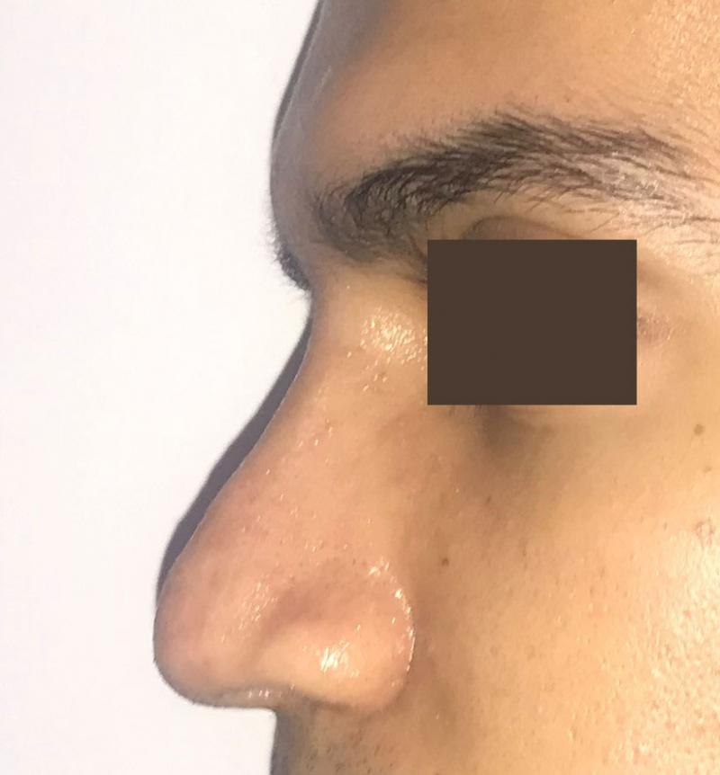 Nose job, Rhinoplasty, Tip definition, Dorsal Hump, Big nose, Best Plastic