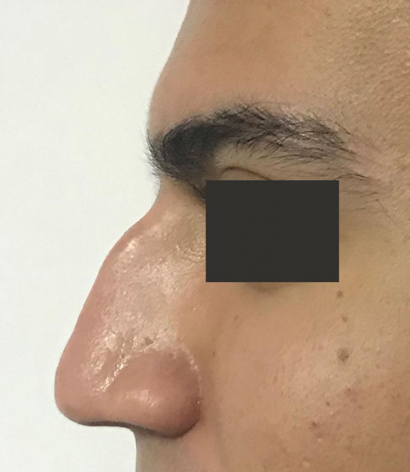 Nose job, Rhinoplasty, Tip definition, Dorsal Hump, Big nose, Best Cosmetic