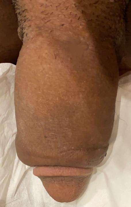 Small Penis, Penis Fat Injection, Penis Juvederm, Suspensory Ligament Release