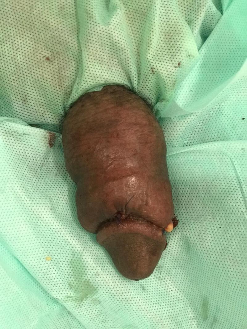 Increase Penis Girth and Penis Length by Fat Injection at Best Plastic Surgery