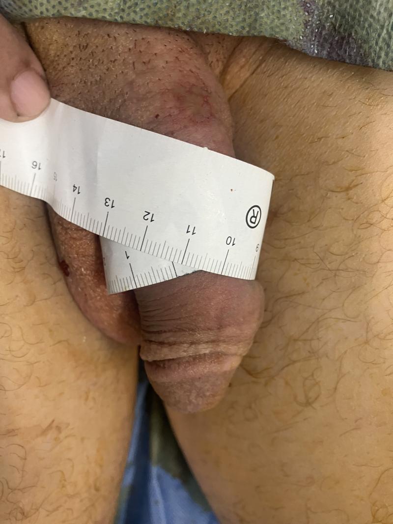 Small penis Enlarged by Fat Injection: Penis Elongation at Best Aesthetic Surger