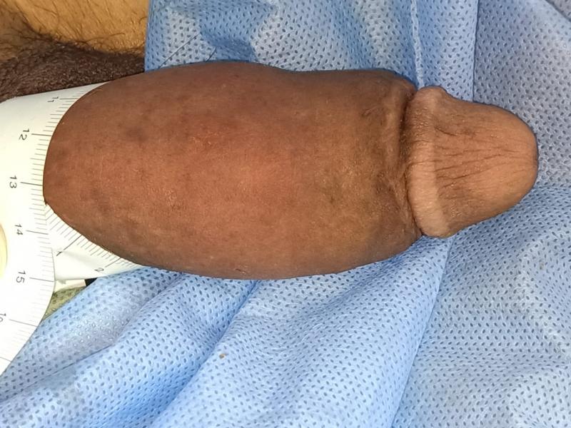 Small penis enlarged by Fat grafting by Best Aesthetic surgeon in Egypt by 2 inc