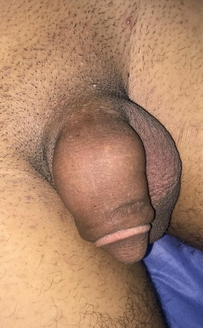 Small Penis, Penis Fat Injection, Penis Juvederm Filler, Suspensory Ligament
