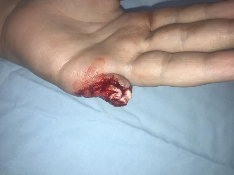 Best Plastic Surgery in Egypt, hand trauma treated at Best Cosmetic Surgery 
