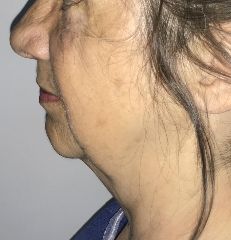 Plastic Surgery in Egypt for Neck Lift and Vaser Neck High Definition Liposuctio