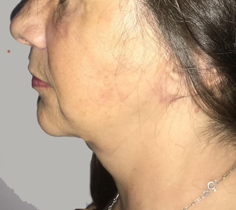 Cosmetic Surgery Egypt for Neck Lift and High Definition Neck Vaser Liposuction