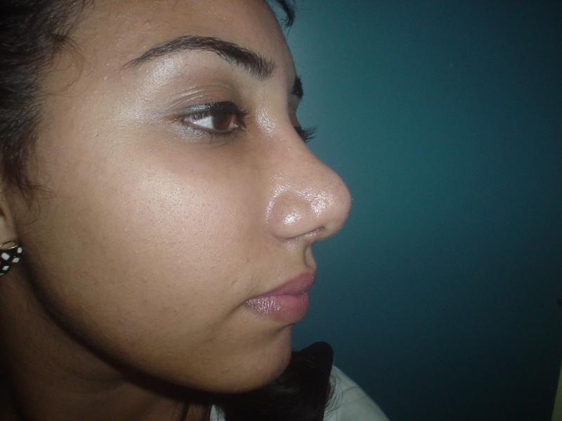 Cosmetic surgery Egypt,fat Injection,Nose job,Laser Liposuction,Aesthetic