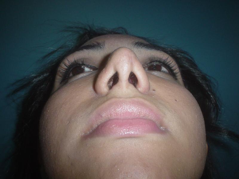 Plastic surgery Egypt,Tip reduction,Nose job,Cosmetic Surgery,Rhinoplasty