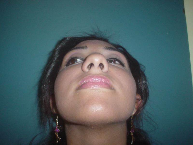 Cosmetic surgery Egypt,Nose Job,Rhinoplasty,Boxy tip,Plastic Surgery Egypt