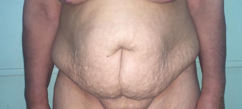 علاج السمنة المفرطة, شد البطن و الترهلات , شفط ا لدهون باللفيزر,  جراحة تجميل