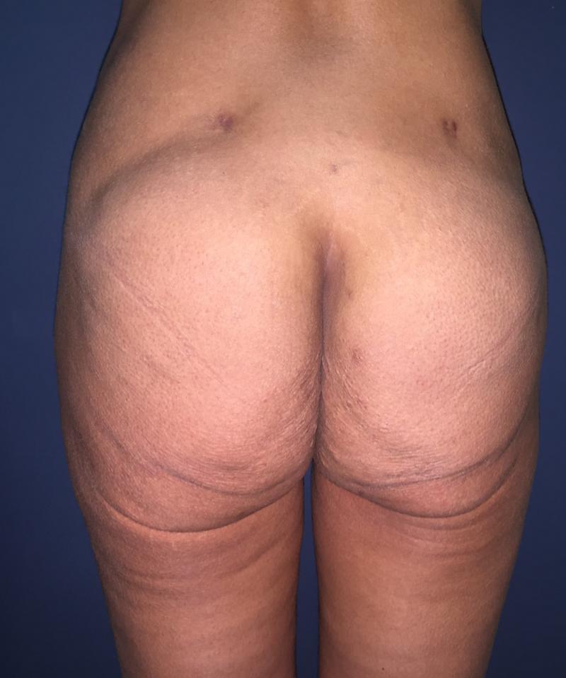 Butt Augmentation, Gastric Band, Massive weight obesity, Best Cosmetic Surgery