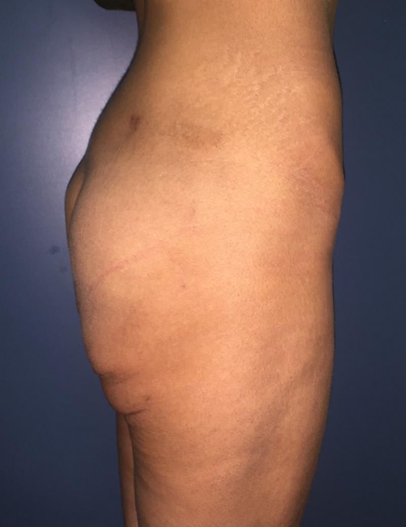 Butt Enlargement Egypt, Butt Enhancement, Silicon Inplants, Best Cosmetic Surger