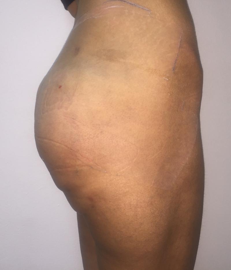 Butt Enlargement Egypt, Butt Enhancement, Silicon Inplants, Best Plastic Surger