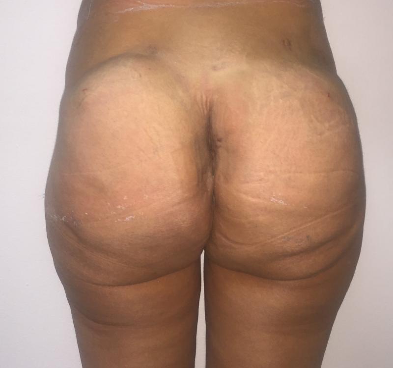Butt Augmentation, Gastric Band, Massive weight obesity, Best Plastic Surgery