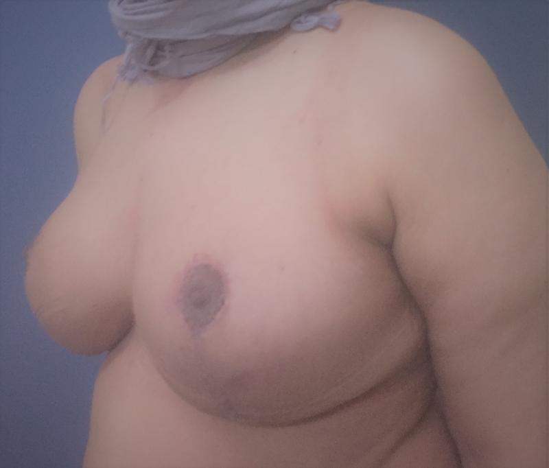 Breast reduction Lift Mastopexy, Laser Liposuction, Reduction Mammoplasty, Cosmt