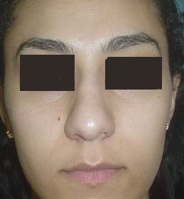 Nose Job, Rhinoplasty, Nasal Hump, Big tip, Best Aesthetic Surgeon, Nose Reduce