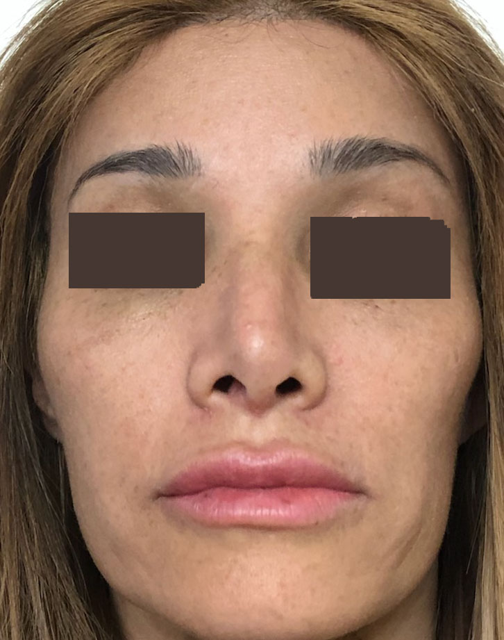 Nose job, Rhinoplasty, Tip definition, Tip elevation, Dorsal Hump, Best Plastic