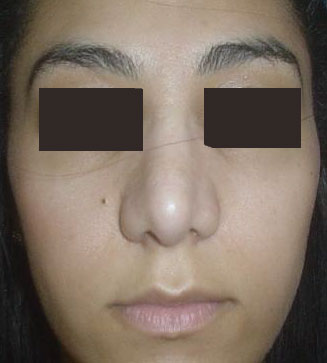 Nose Job, Rhinoplasty, Nasal Hump, Big tip, Best Plastic Surgeon, Nose surgery
