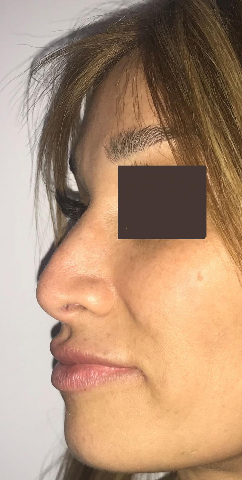 Nose job, Rhinoplasty, Tip definition, Tip elevation, Dorsal Hump, Best Aesthetc