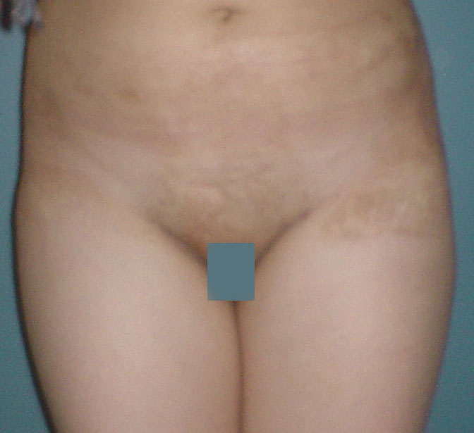 Cosmetic Surgery Egypt, Aesthetic Surgery, Laser, Fraxel Laser, Burn, Scar,