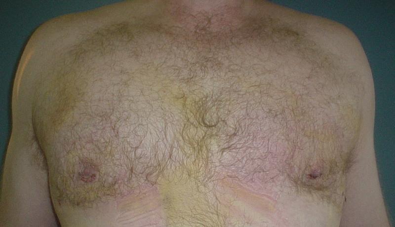 Gynecomastia Egypt, Male Breast Reduction, Vaser Liposuction, Best Cosmtic Surge