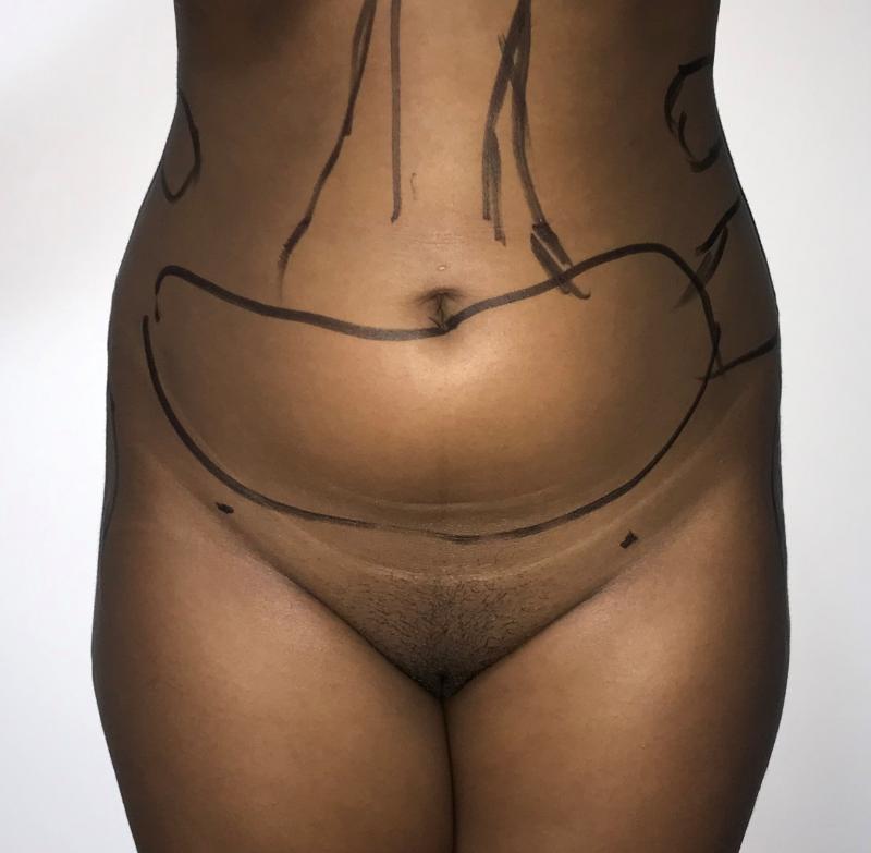 Hip Enlargement, Hip Augmentation, Fat Injection, Fat Grafting, Best Cosmetic