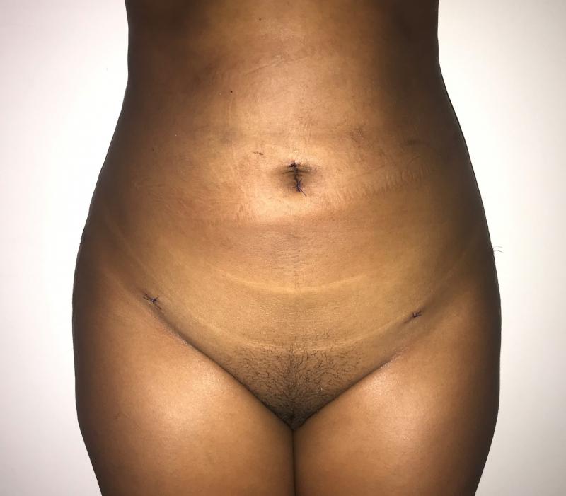 Hip Enlargement, Hip Augmentation, Fat Injection, Fat Grafting, Best Plastic