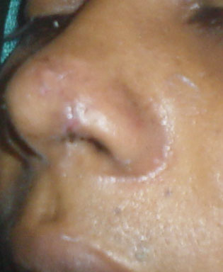 Cosmetic Surgery in Egypt,Nasal tip,Plastic Surgery Egypt,Smart liposuction