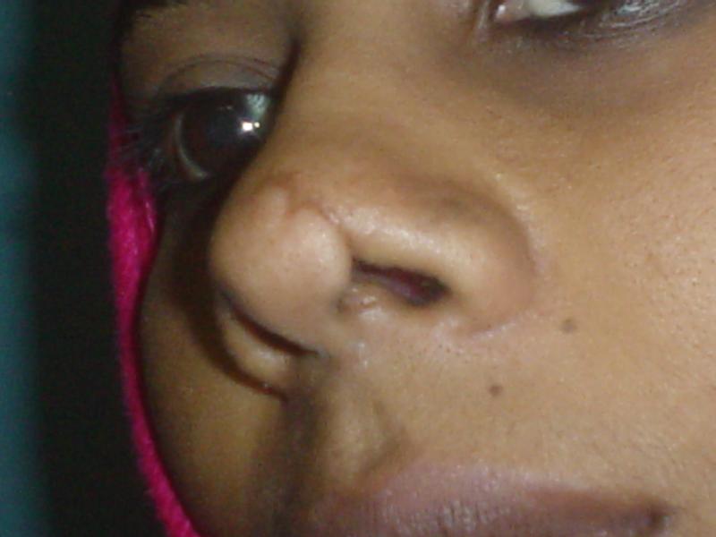 Plastic Surgery Egypt,Nose job,Cosmetic surgery egypt,Rhinoplasty,Nasal tip
