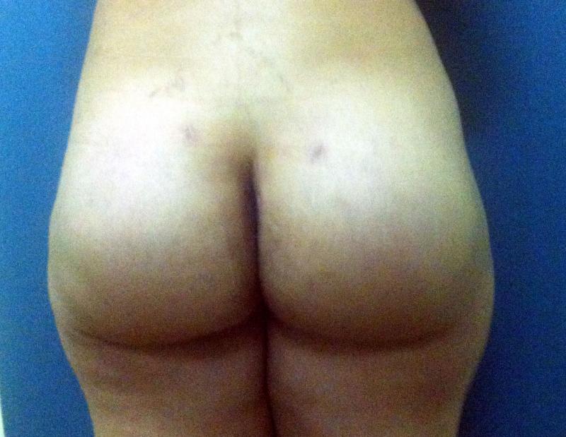 Butt Augmentation Ptosis Egypt, Breast Lift Egypt, Mastopexy, Cosmetic Surgery