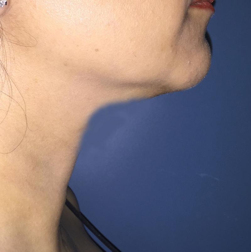 Neck lift, Neck Liposuction, Vaser Liposuction, Best Cosmetic Surgery Egypt