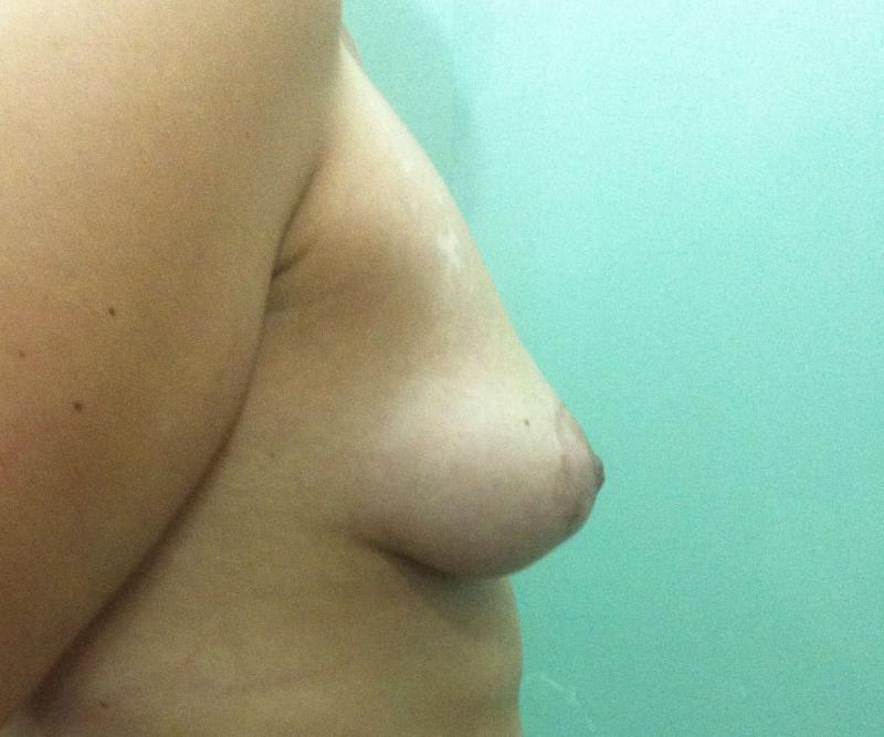 Fat Injection EGYPT, Fat grafting Egypt, Stem Cells Egypt, Breast Enhancement