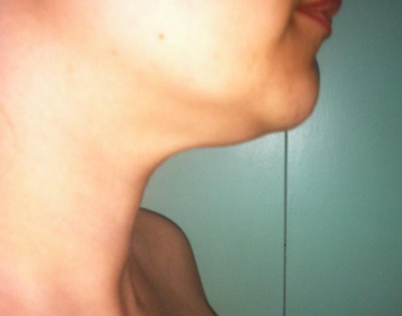 Neck lift, Neck Liposuction, Laser Liposuction, Best Cosmetic Surgery Egypt 