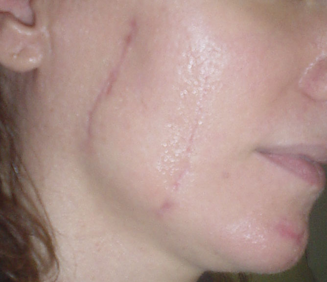 Stem cells, Stem cells for scars, Face scars, Stem cell laser, Cosmetic Surgery