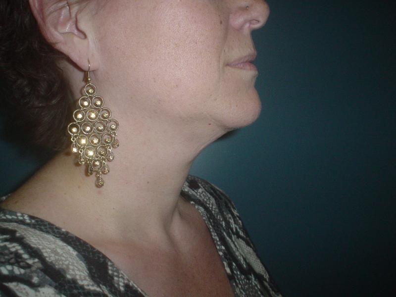 Best Plastic Surgery Egypt, Neck Lift, Laser Liposuction, Vaser Liposuction