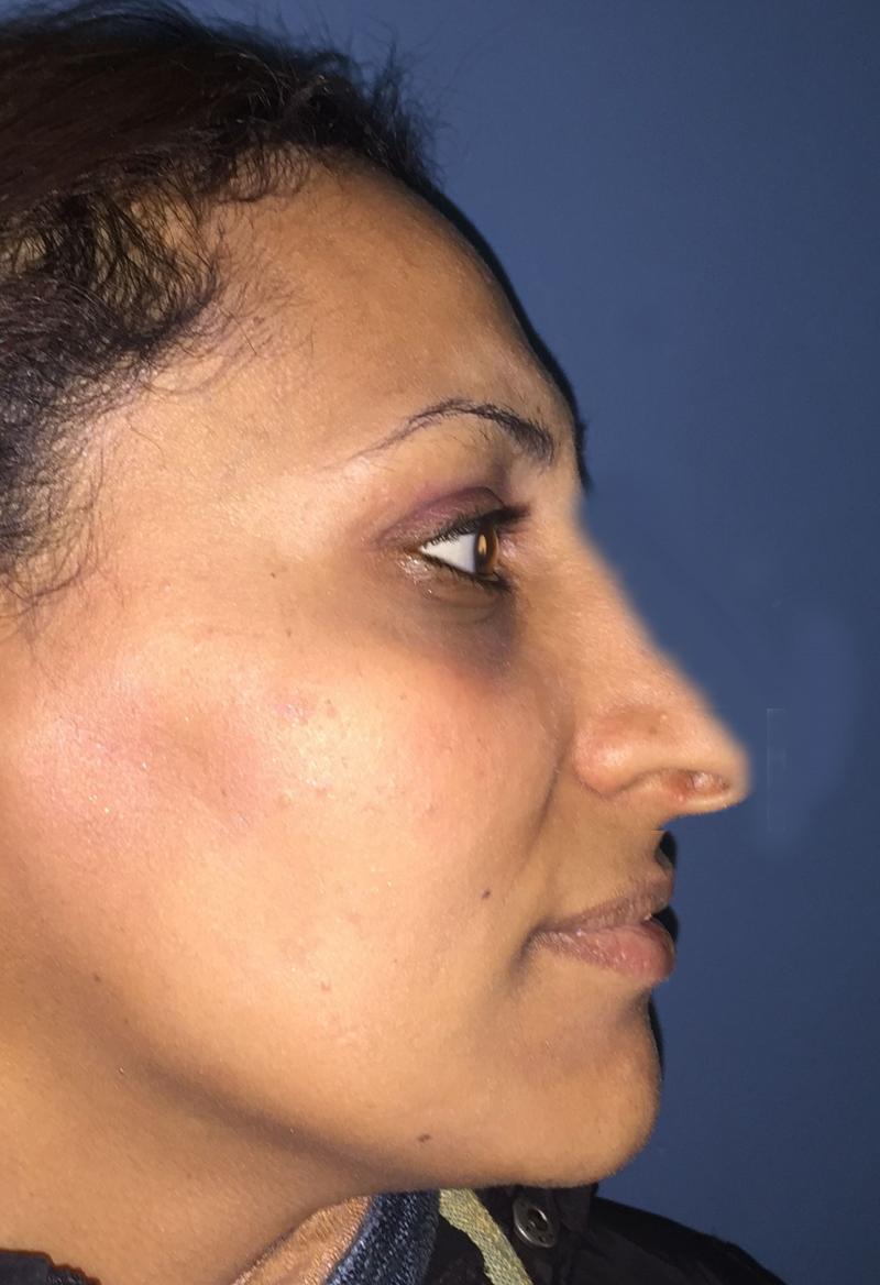 Nose Job, Rhinoplasty, Nasal Hump, Big tip, Best Cosmetic Surgeon, Deviated nose
