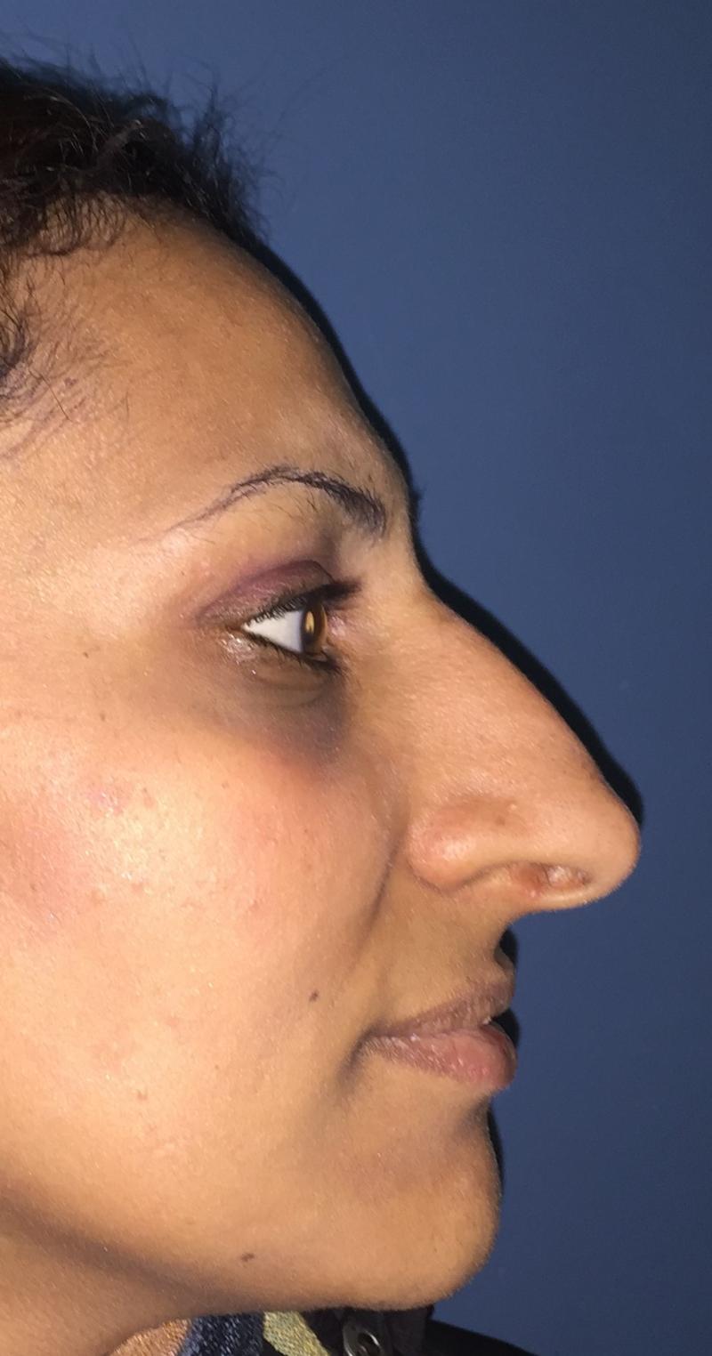Nose Job, Rhinoplasty, Nasal Hump, Big tip, Best Plastic Surgeon, Deviated nose