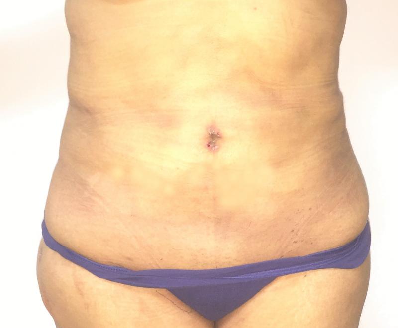 Abdominal Liposuction, Laser Liposuction, Liposculpture, Cosmetic Surgery Egypt