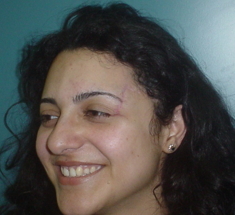 Plastic surgery egypt cosmetic wound scar laser filler deformity