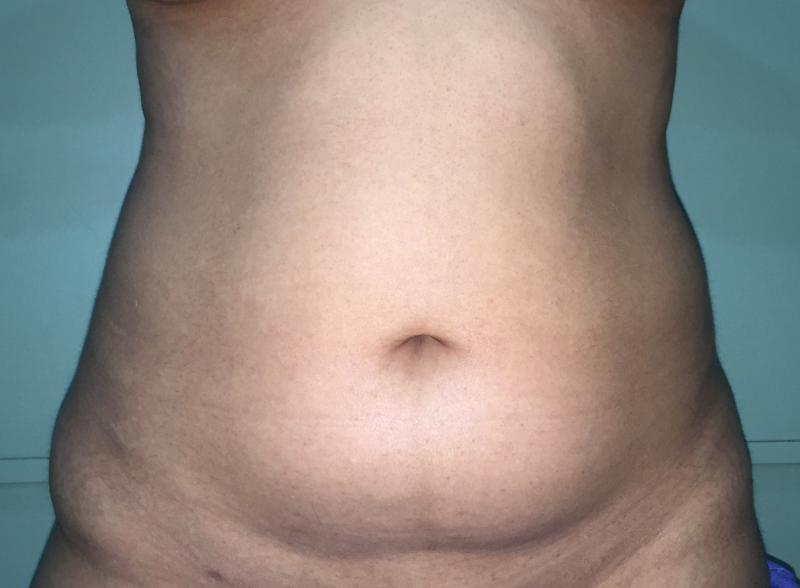 Abdominal Liposuction, Laser Liposuction, Liposculpture, Plastic Surgery Egypt