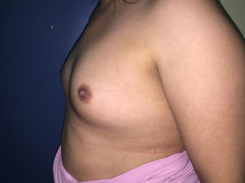Breast Enlargement, BreastLift, Augmentation Mastopexy, Fat Injection Cosmetic