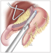Best Plastic surgeon in Egypt, Bariatric surgery, Sleeve Gastrectomy, Obesity