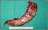 Morbid Obesity in Egypt, Sleeve Gastrectomy, Weight loss, Plastic Surgery Egypt
